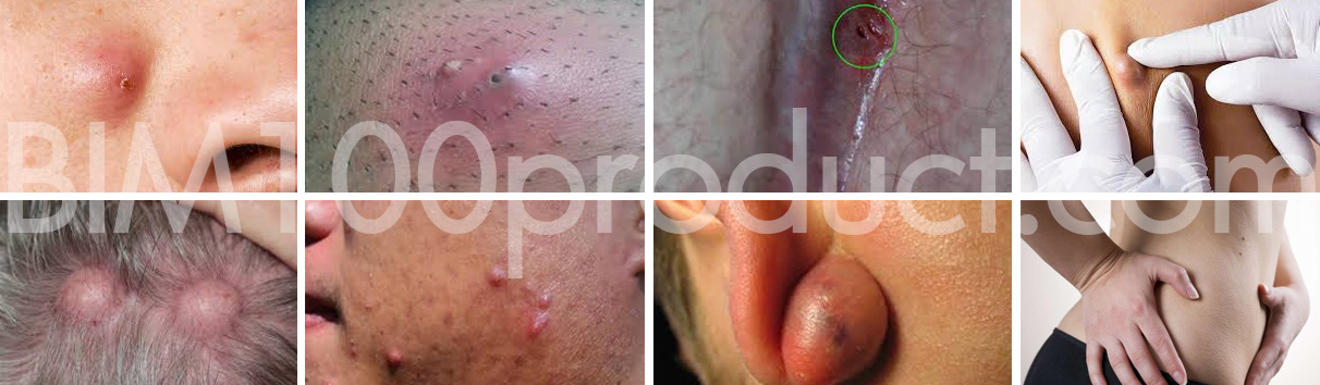 CYSTS
